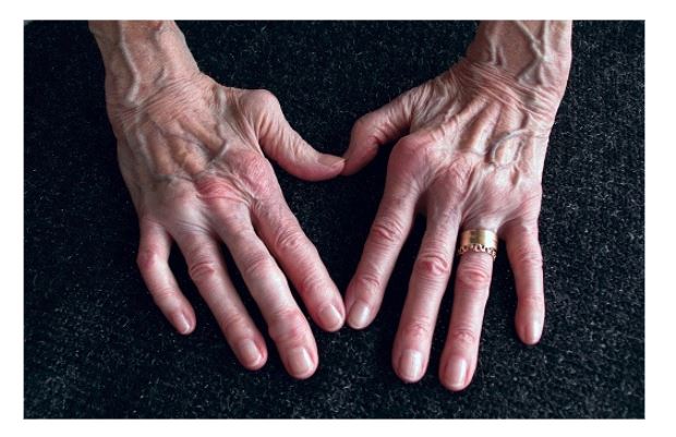 Cum să scapi de artrită pe degete